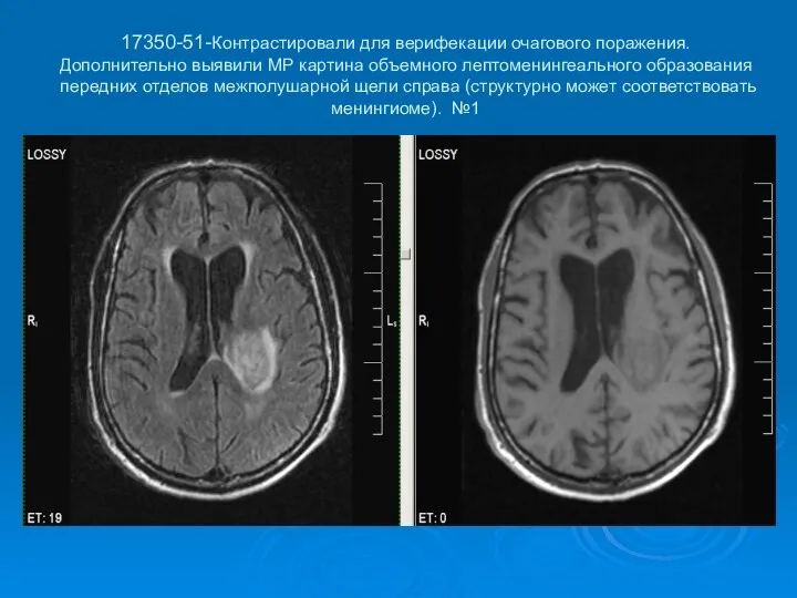 17350-51-Контрастировали для верифекации очагового поражения. Дополнительно выявили МР картина объемного лептоменингеального