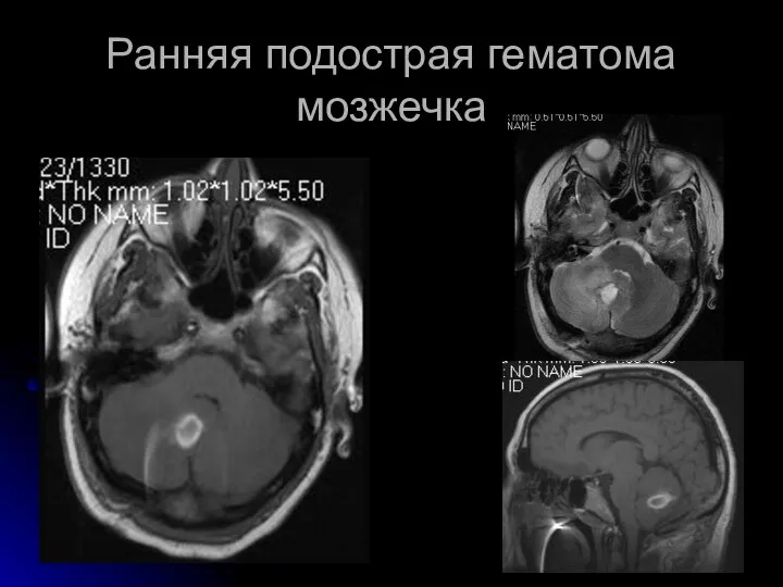 Ранняя подострая гематома мозжечка