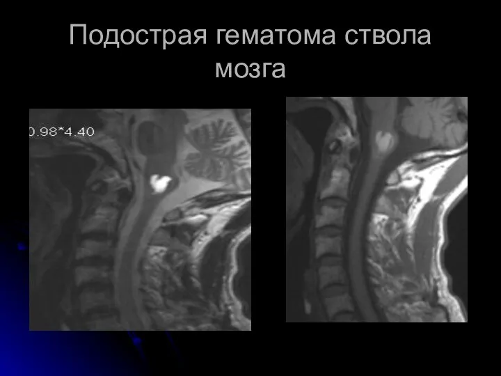 Подострая гематома ствола мозга