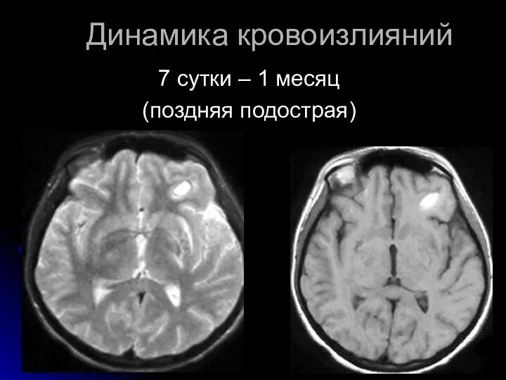 Динамика кровоизлияний 7 сутки – 1 месяц (поздняя подострая)