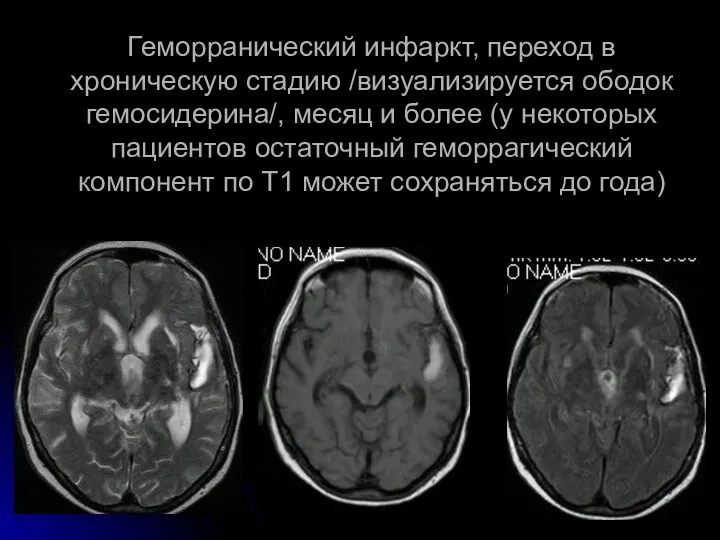 Геморранический инфаркт, переход в хроническую стадию /визуализируется ободок гемосидерина/, месяц и