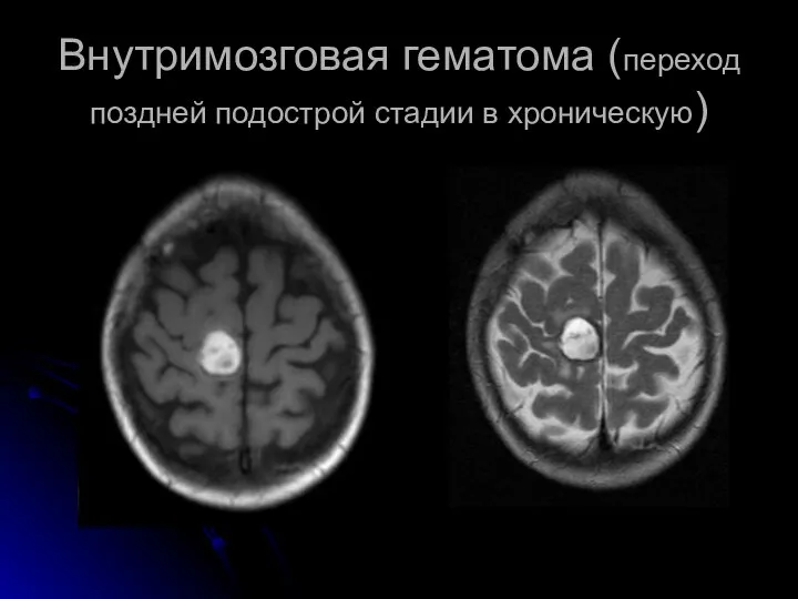 Внутримозговая гематома (переход поздней подострой стадии в хроническую)