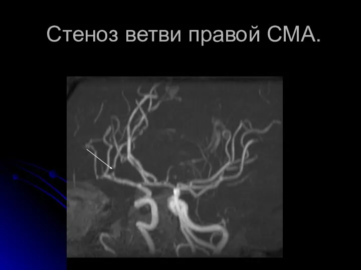 Стеноз ветви правой СМА.