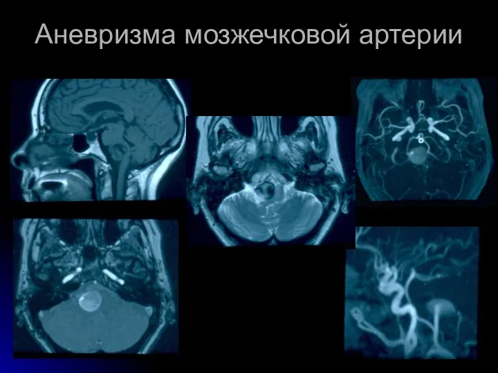 Аневризма мозжечковой артерии