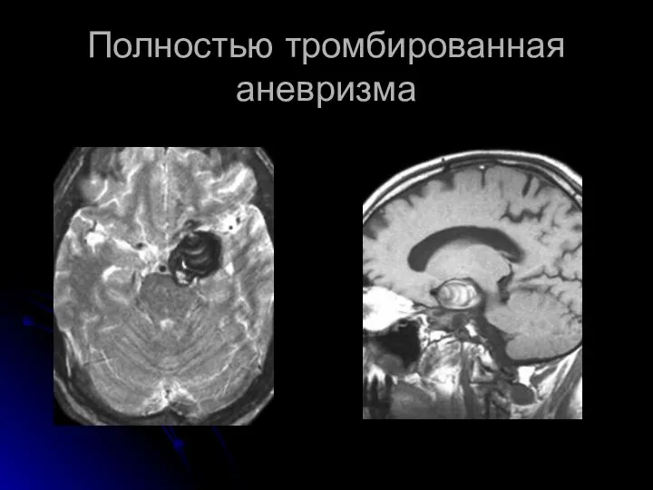 Полностью тромбированная аневризма