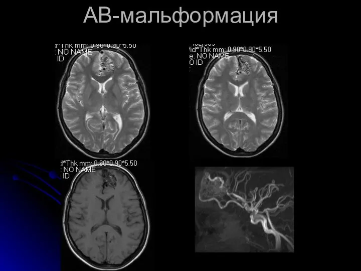 АВ-мальформация