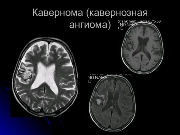 Кавернома (кавернозная ангиома)