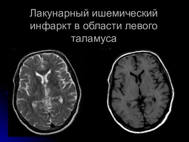 Лакунарный ишемический инфаркт в области левого таламуса