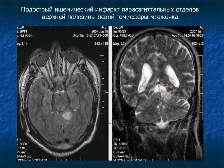 Подострый ишемический инфаркт парасагиттальных отделов верхней половины левой гемисферы мозжечка