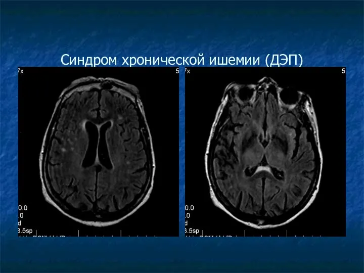 Синдром хронической ишемии (ДЭП)