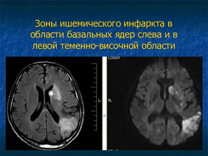 Зоны ишемического инфаркта в области базальных ядер слева и в левой теменно-височной области