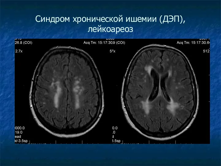 Синдром хронической ишемии (ДЭП), лейкоареоз