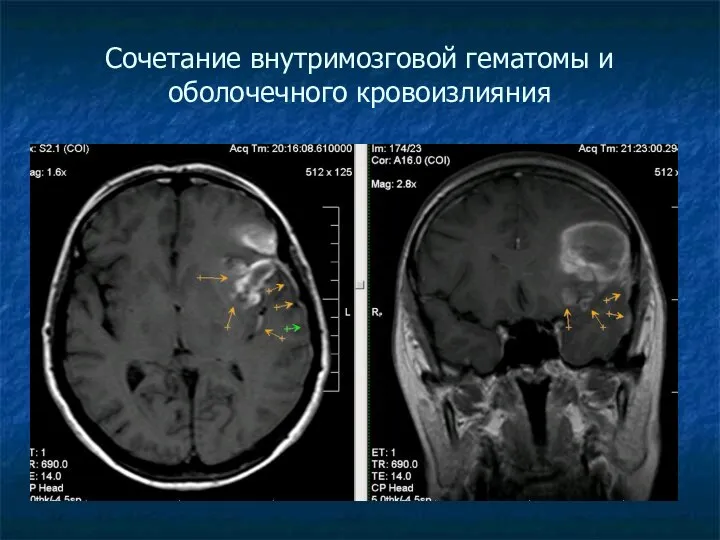 Сочетание внутримозговой гематомы и оболочечного кровоизлияния