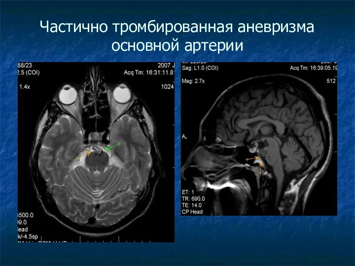 Частично тромбированная аневризма основной артерии