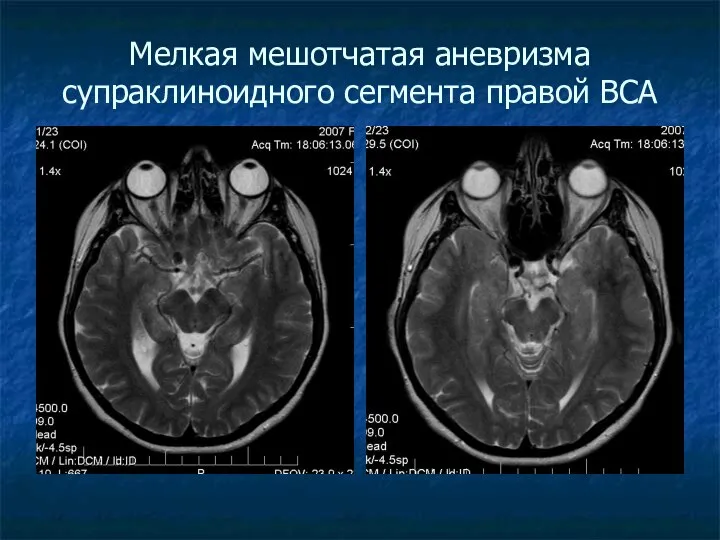 Мелкая мешотчатая аневризма супраклиноидного сегмента правой ВСА