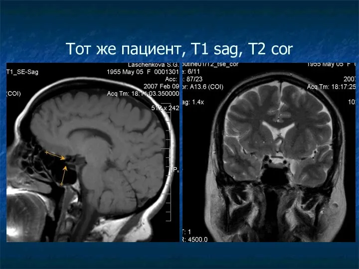 Тот же пациент, Т1 sag, Т2 cor