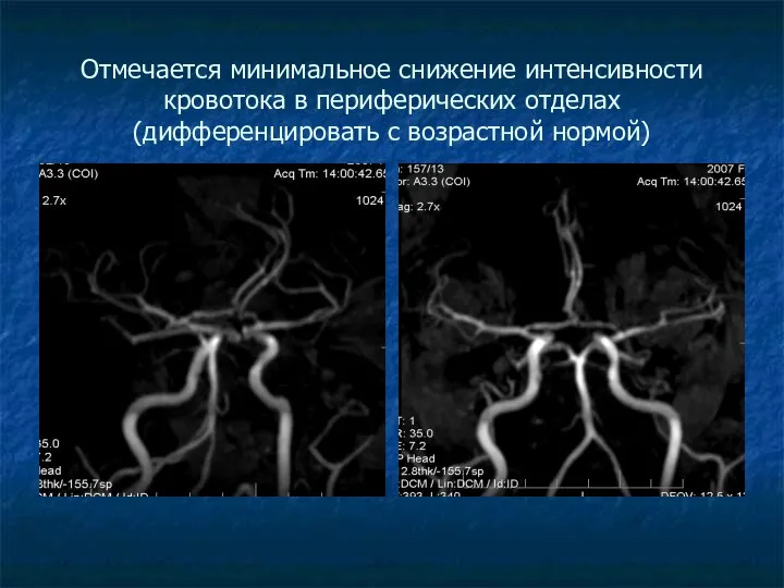 Отмечается минимальное снижение интенсивности кровотока в периферических отделах (дифференцировать с возрастной нормой)