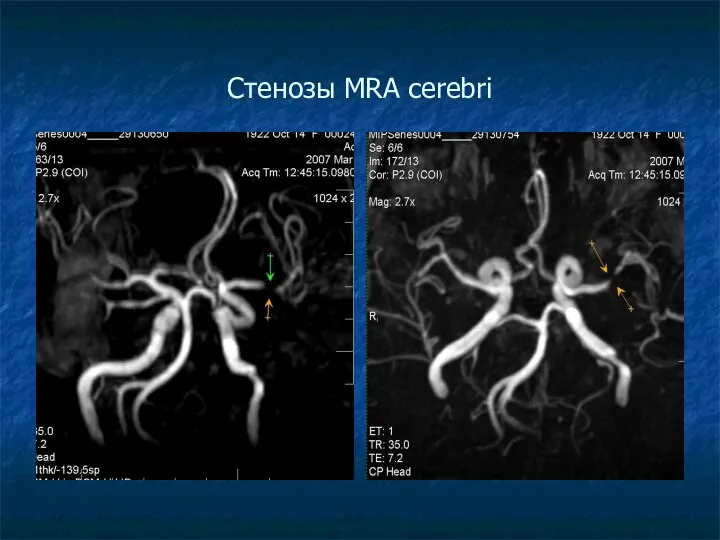 Стенозы MRA cerebri