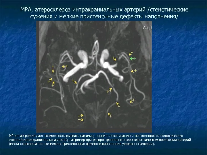 МРА, атеросклероз интракраниальных артерий /стенотические сужения и мелкие пристеночные дефекты наполнения/