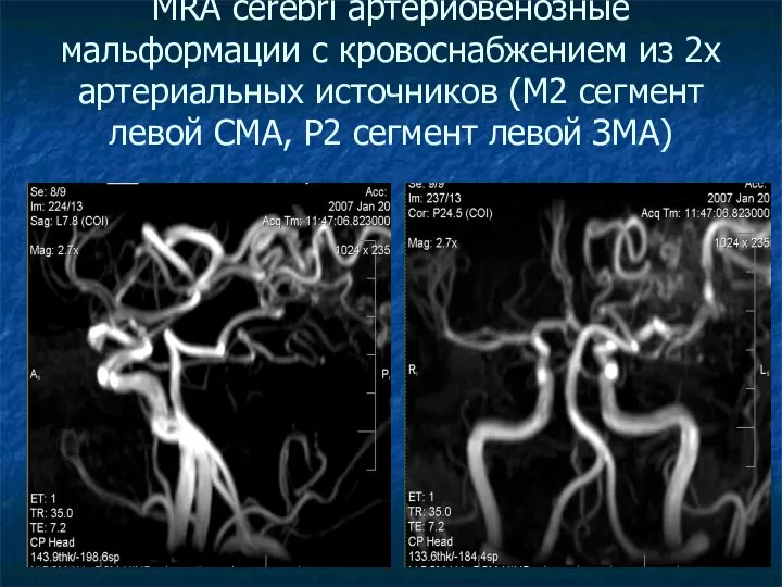 MRA cerebri артериовенозные мальформации с кровоснабжением из 2х артериальных источников (М2