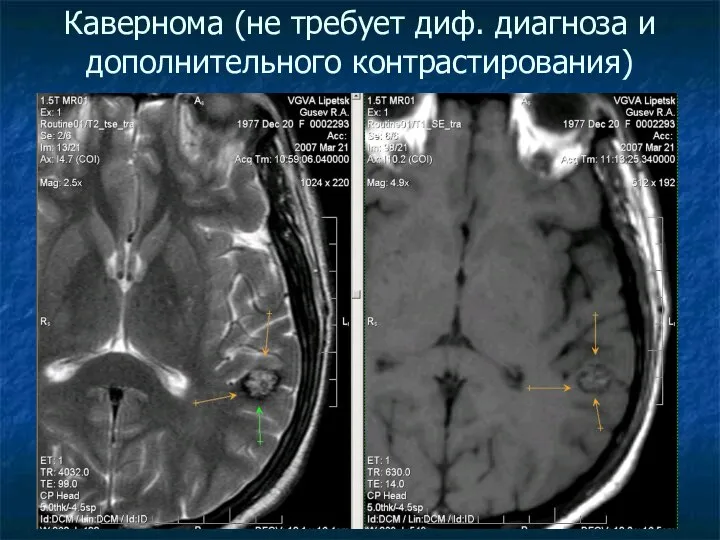 Кавернома (не требует диф. диагноза и дополнительного контрастирования)