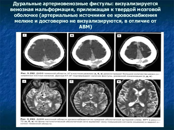 Дуральные артериовенозные фистулы: визуализируется венозная мальформация, прилежащая к твердой мозговой оболочке