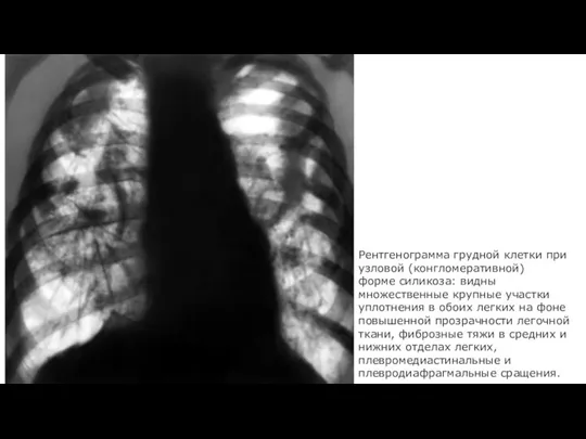 Рентгенограмма грудной клетки при узловой (конгломеративной) форме силикоза: видны множественные крупные