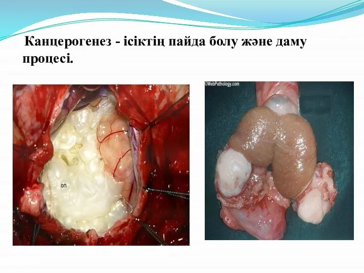 Канцерогенез - ісіктің пайда болу және даму процесі.