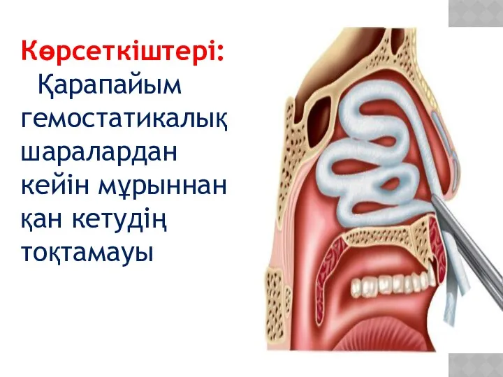 Көрсеткіштері: Қарапайым гемостатикалық шаралардан кейін мұрыннан қан кетудің тоқтамауы