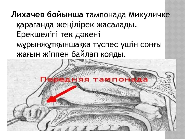 Лихачев бойынша тампонада Микуличке қарағанда жеңілірек жасалады. Ерекшелігі тек дәкені мұрынжұтқыншаққа