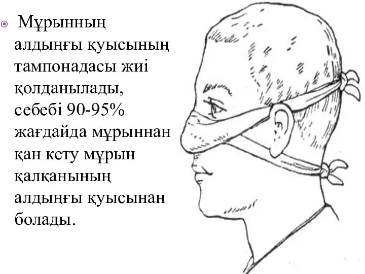 Мұрынның алдыңғы қуысының тампонадасы жиі қолданылады, себебі 90-95% жағдайда мұрыннан қан