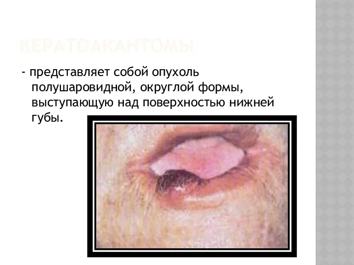 КЕРАТОАКАНТОМЫ - представляет собой опухоль полушаровидной, округлой формы, выступающую над поверхностью нижней губы.