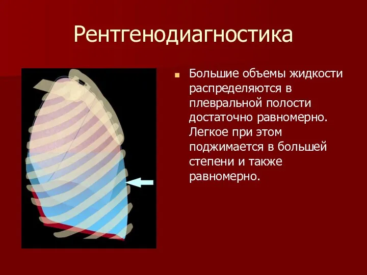 Рентгенодиагностика Большие объемы жидкости распределяются в плевральной полости достаточно равномерно. Легкое