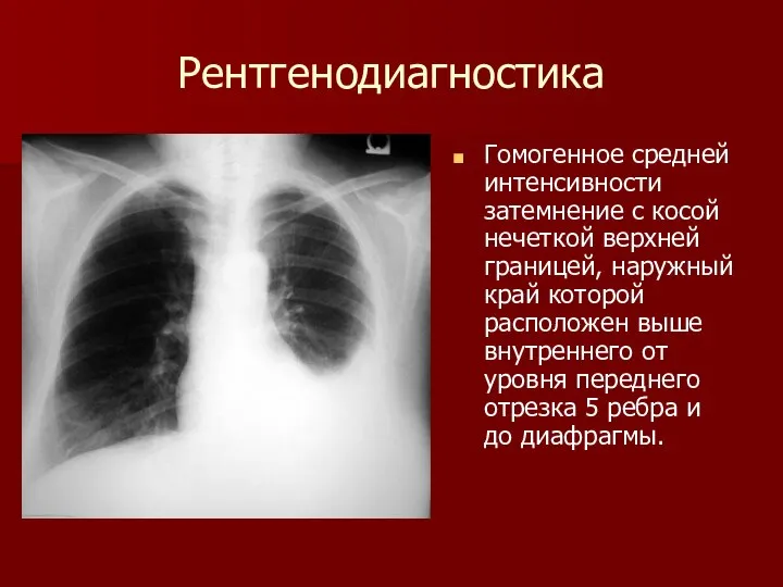 Рентгенодиагностика Гомогенное средней интенсивности затемнение с косой нечеткой верхней границей, наружный