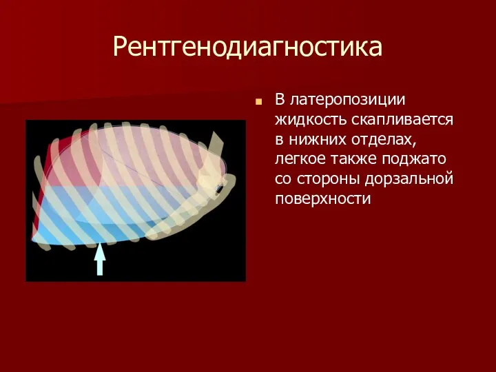 Рентгенодиагностика В латеропозиции жидкость скапливается в нижних отделах, легкое также поджато со стороны дорзальной поверхности