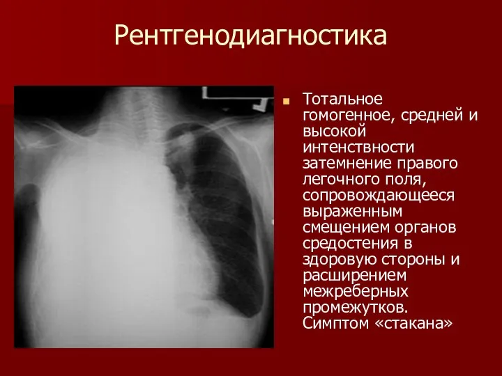 Рентгенодиагностика Тотальное гомогенное, средней и высокой интенствности затемнение правого легочного поля,