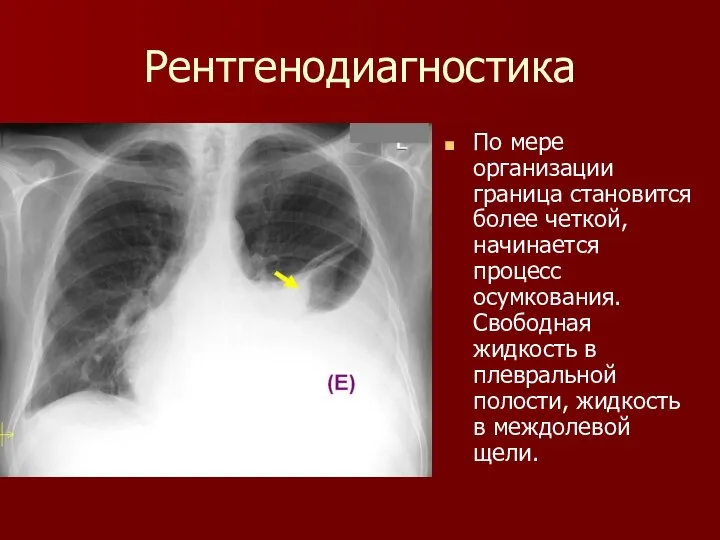 Рентгенодиагностика По мере организации граница становится более четкой, начинается процесс осумкования.