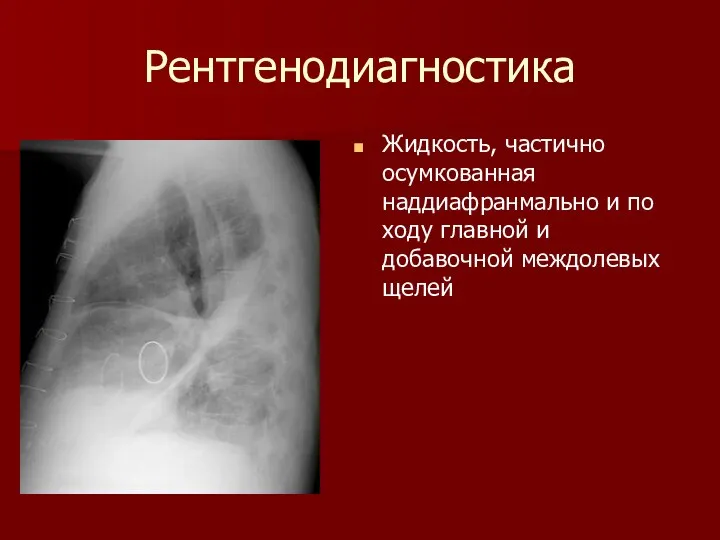 Рентгенодиагностика Жидкость, частично осумкованная наддиафранмально и по ходу главной и добавочной междолевых щелей