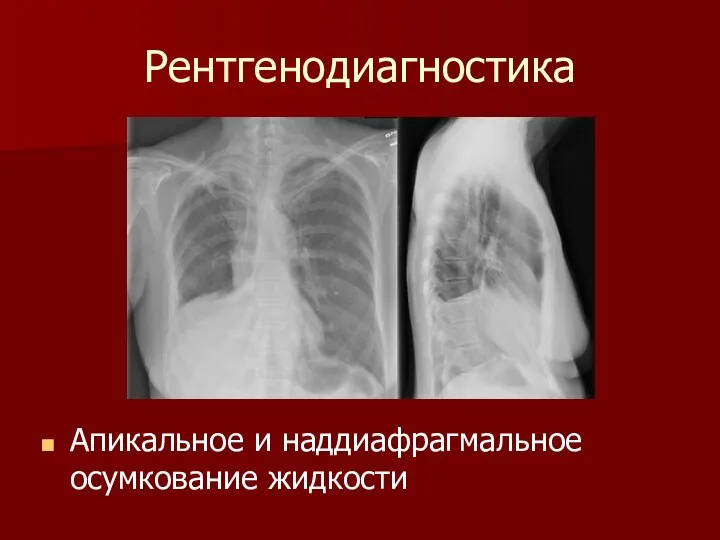 Рентгенодиагностика Апикальное и наддиафрагмальное осумкование жидкости