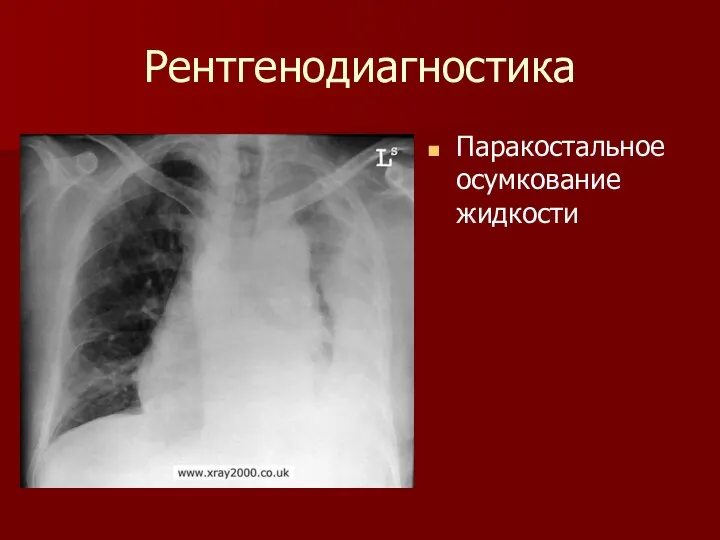 Рентгенодиагностика Паракостальное осумкование жидкости