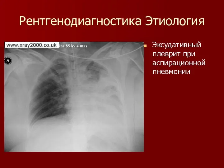 Рентгенодиагностика Этиология Эксудативный плеврит при аспирационной пневмонии