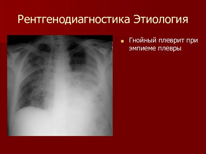 Рентгенодиагностика Этиология Гнойный плеврит при эмпиеме плевры