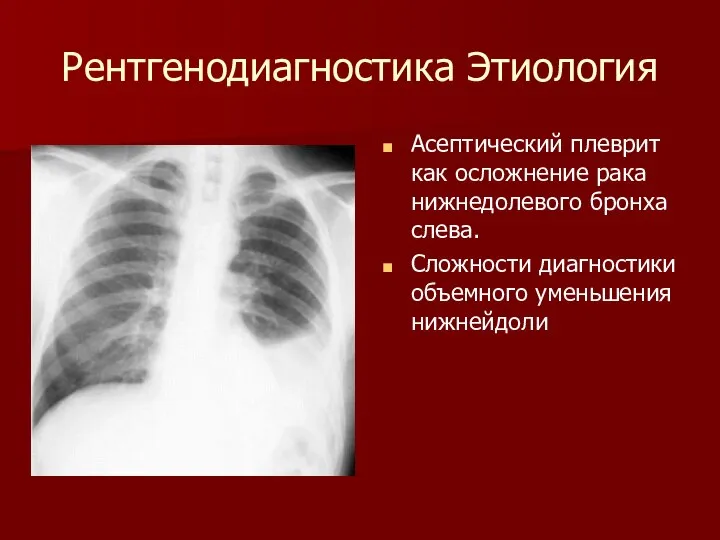 Рентгенодиагностика Этиология Асептический плеврит как осложнение рака нижнедолевого бронха слева. Сложности диагностики объемного уменьшения нижнейдоли