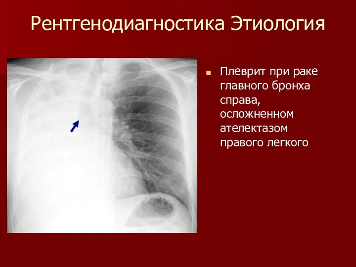 Рентгенодиагностика Этиология Плеврит при раке главного бронха справа, осложненном ателектазом правого легкого