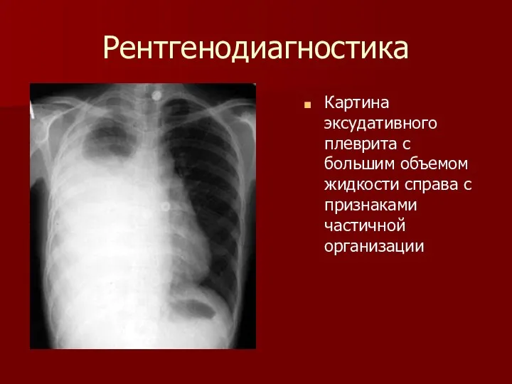 Рентгенодиагностика Картина эксудативного плеврита с большим объемом жидкости справа с признаками частичной организации