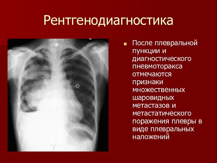 Рентгенодиагностика После плевральной пункции и диагностического пневмоторакса отмечаются признаки множественных шаровидных