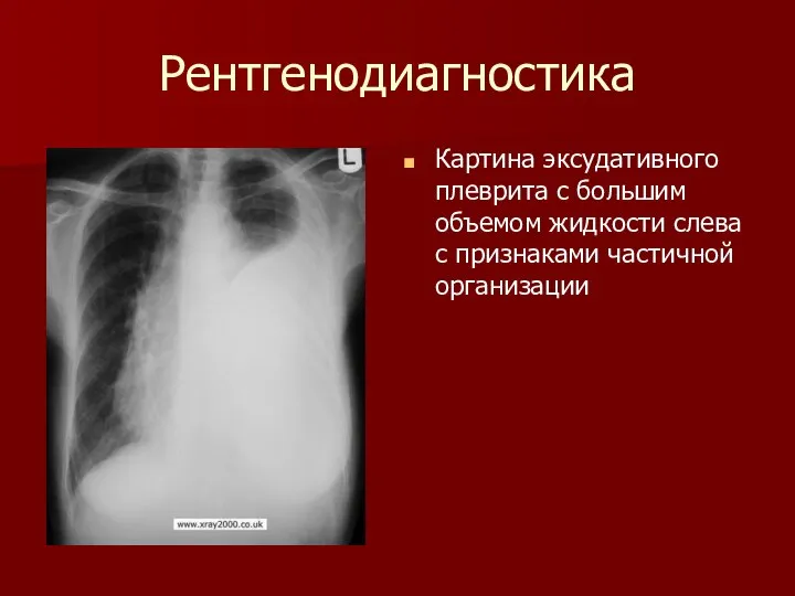 Рентгенодиагностика Картина эксудативного плеврита с большим объемом жидкости слева с признаками частичной организации