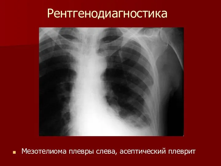 Рентгенодиагностика Мезотелиома плевры слева, асептический плеврит