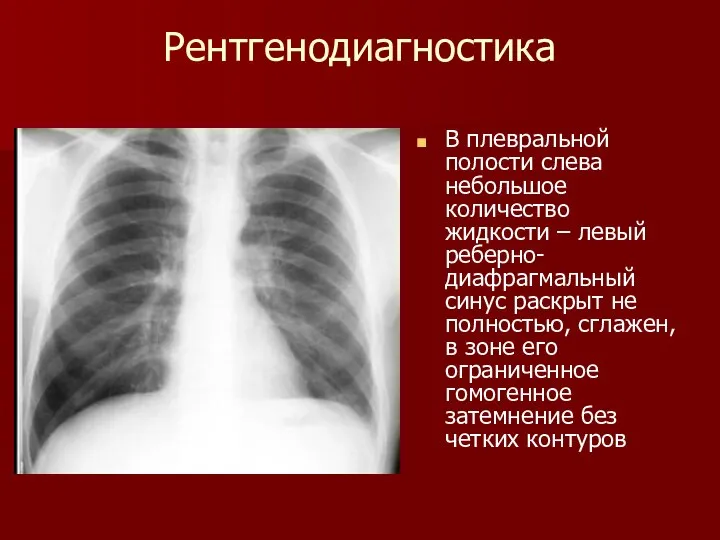 Рентгенодиагностика В плевральной полости слева небольшое количество жидкости – левый реберно-диафрагмальный