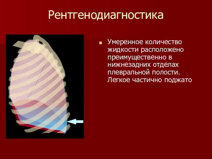 Рентгенодиагностика Умеренное количество жидкости расположено преимущественно в нижнезадних отделах плевральной полости. Легкое частично поджато